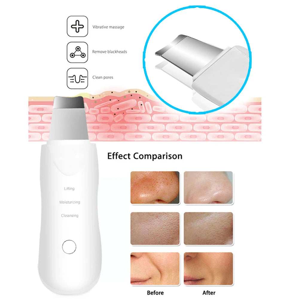 Limpiador Facial Ultrasónico Eaura Care — Puntos Negros